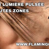 Epilation définitive lumière pulsée Nice