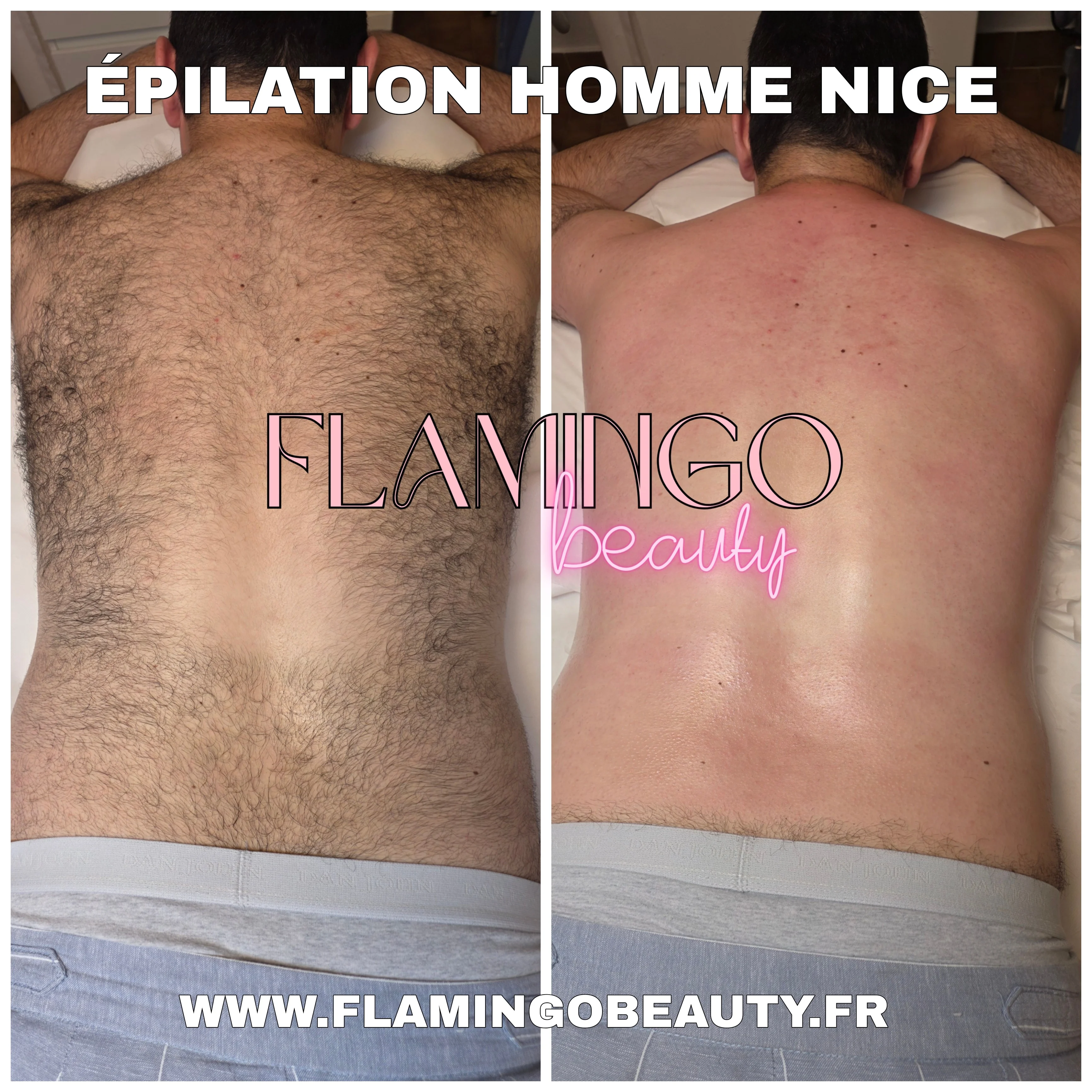 Epilation homme du dos à Nice avant apres