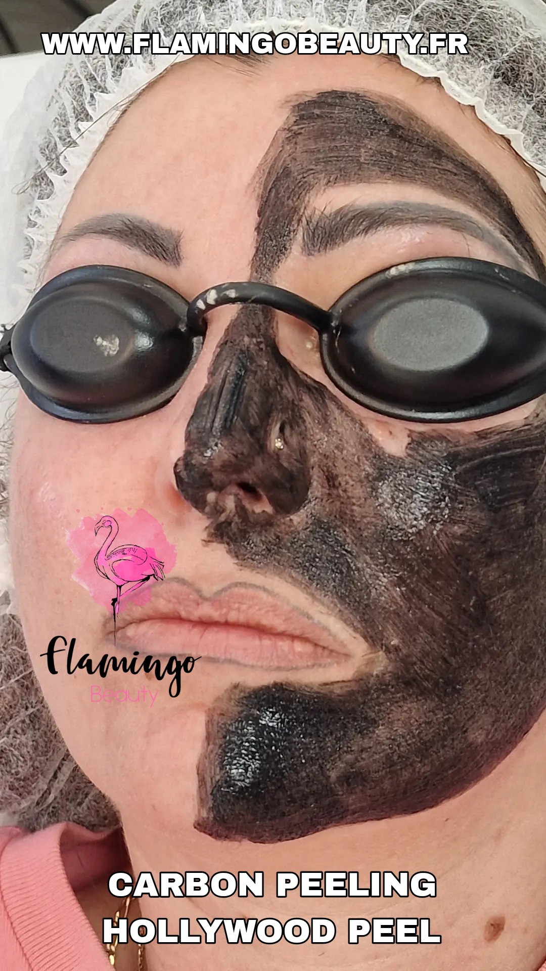 soin visage CARBON PEEL Nice