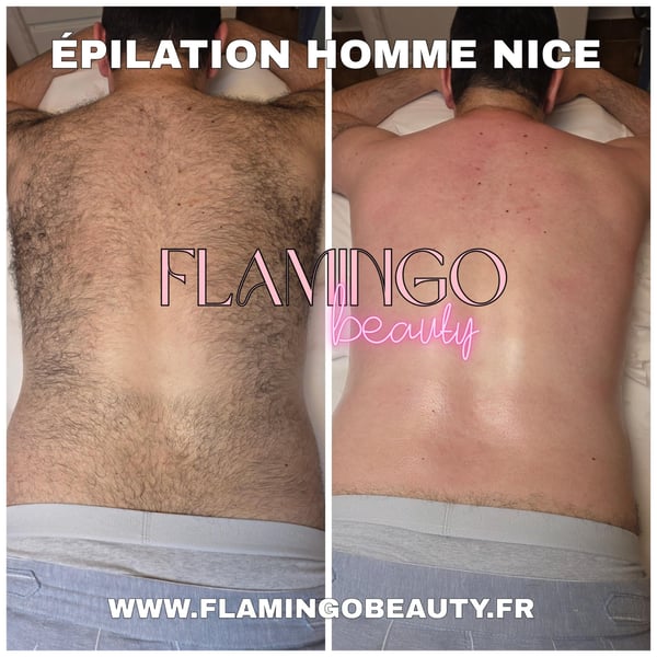 Épilation du dos à la cire pour homme à Nice, comparaison avant et après la séance