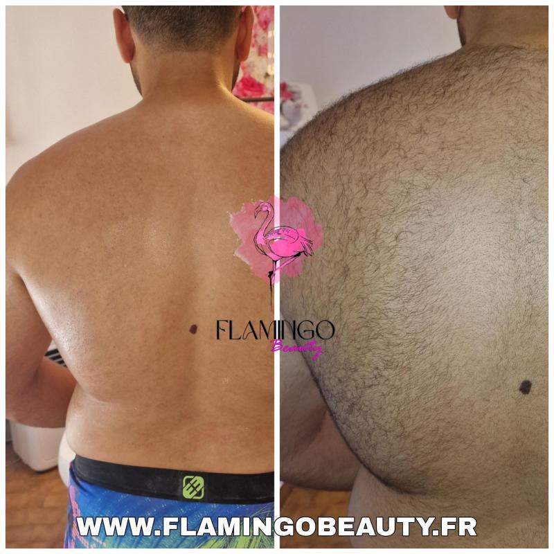 Epilation homme nice