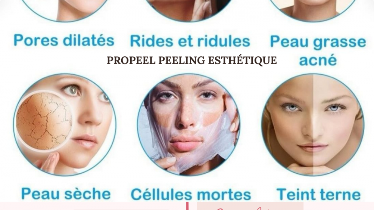 Peelingesthétique et Photoréjuvénation (IPL) à Nice